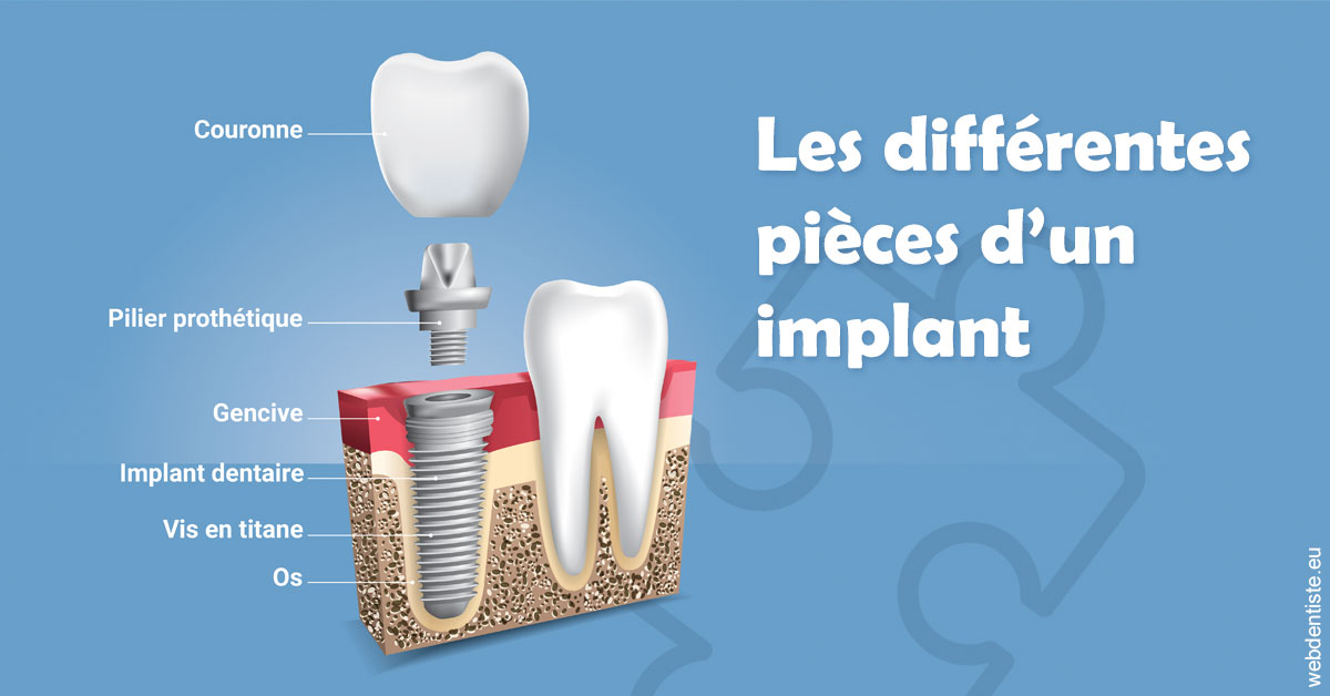 https://www.drbenoitphilippe.com/Les différentes pièces d’un implant 1