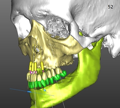 Jaw Surgery Orthognathic Surgery