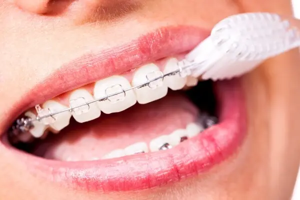 Orthodontie et hygiène bucco-dentaire